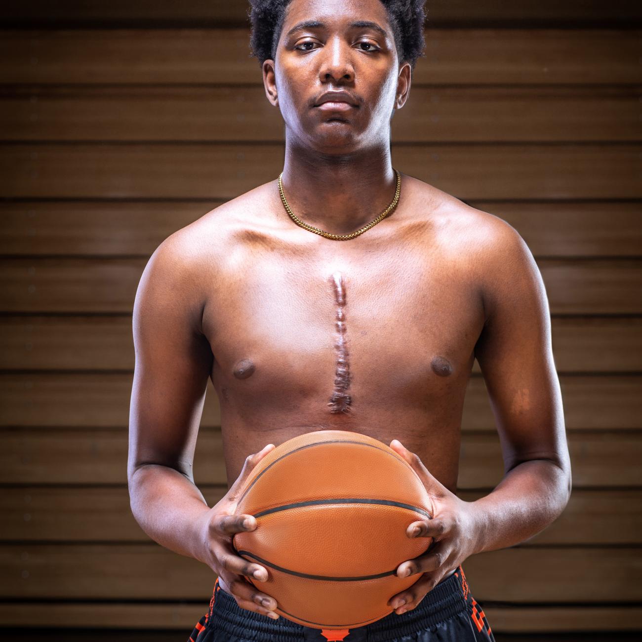 Dylan Kambalay holding a basketball showing the scar from his heart transplant